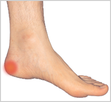 a change or increase in activities, no arch support, lack of flexibility in the calf muscles, being overweight, a sudden injury, using shoes with little